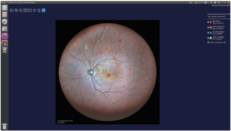 Microclear-RetinaAssistant.png